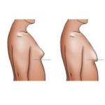 Gynecomastia
